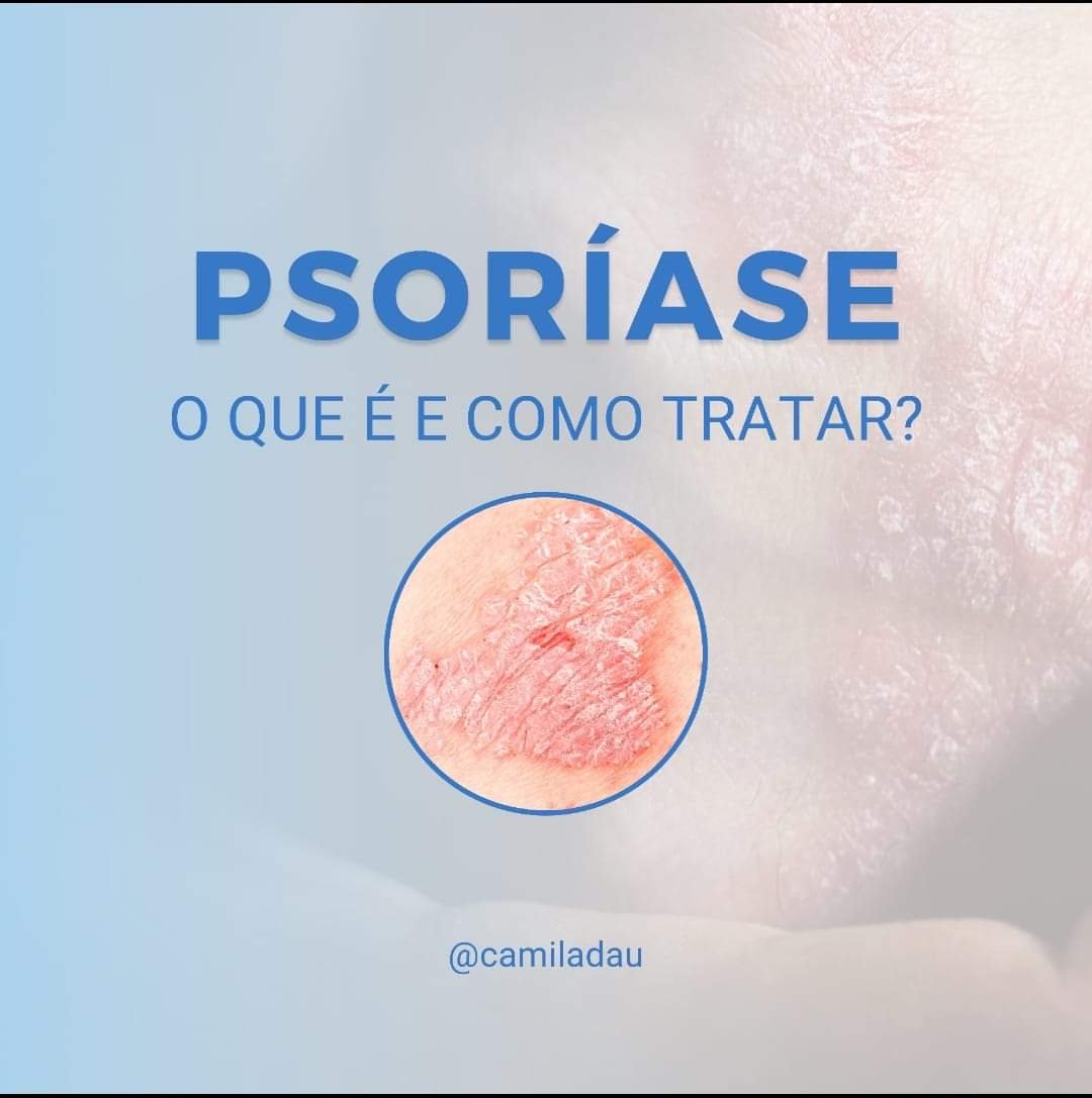 Psoríase - O que é e como Tratar? - Marlon Câmara Lopes